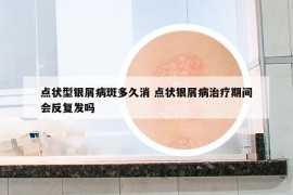 點(diǎn)狀型銀屑病斑多久消 點(diǎn)狀銀屑病治療期間會(huì)反復(fù)發(fā)嗎