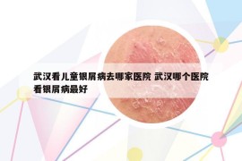 武漢看兒童銀屑病去哪家醫(yī)院 武漢哪個(gè)醫(yī)院看銀屑病最好