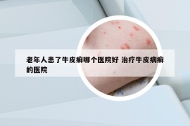 老年人患了牛皮癬哪個醫(yī)院好 治療牛皮病癬的醫(yī)院
