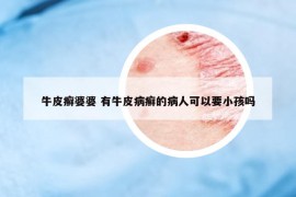 牛皮癬婆婆 有牛皮病癬的病人可以要小孩嗎