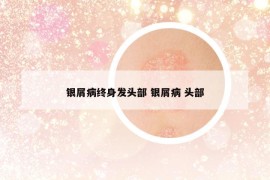 銀屑病終身發(fā)頭部 銀屑病 頭部