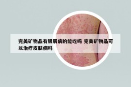 完美礦物晶有銀屑病的能吃嗎 完美礦物晶可以治療皮膚病嗎
