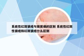 系統(tǒng)性紅斑狼瘡與銀屑病的區(qū)別 系統(tǒng)性紅斑性狼瘡和紅斑狼瘡什么區(qū)別