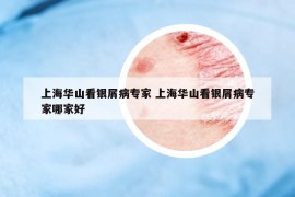 上海華山看銀屑病專家 上海華山看銀屑病專家哪家好