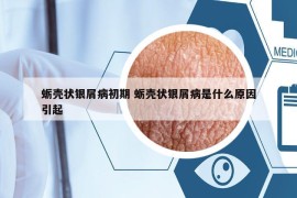 蠣殼狀銀屑病初期 蠣殼狀銀屑病是什么原因引起