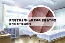 紫花地丁熬水可以治銀屑病嗎 紫花地丁抑菌膏可以用于銀屑病嗎