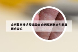 吃阿莫西林誘發(fā)銀屑病 吃阿莫西林會(huì)引起真菌感染嗎