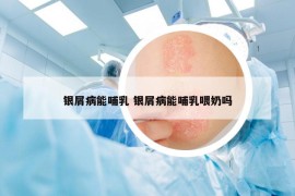 銀屑病能哺乳 銀屑病能哺乳喂奶嗎