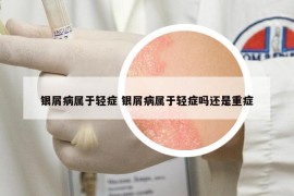 銀屑病屬于輕癥 銀屑病屬于輕癥嗎還是重癥