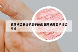 銀屑病關(guān)節(jié)炎手掌手腕痛 銀屑病導(dǎo)致手指關(guān)節(jié)疼