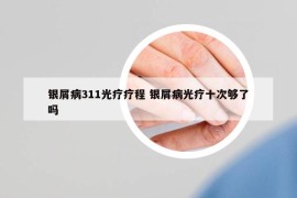 銀屑病311光療療程 銀屑病光療十次夠了嗎