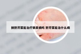 鮮野芹菜能治療銀屑病嗎 野芹菜能治什么病