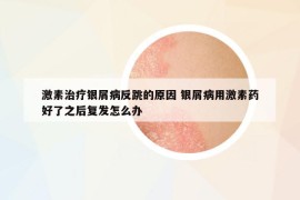 激素治療銀屑病反跳的原因 銀屑病用激素藥好了之后復(fù)發(fā)怎么辦