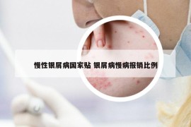 慢性銀屑病國(guó)家貼 銀屑病慢病報(bào)銷(xiāo)比例