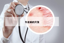 牛皮癬的只發(fā)