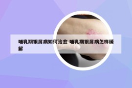 哺乳期銀屑病如何治愈 哺乳期銀屑病怎樣緩解