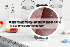 從南京南站打車到醫(yī)科院皮膚病需要多少時(shí)間 南京南站到醫(yī)學(xué)院皮膚病醫(yī)院