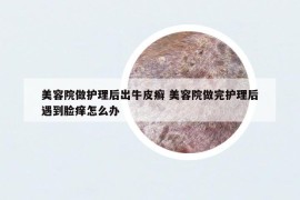 美容院做護(hù)理后出牛皮癬 美容院做完護(hù)理后遇到臉癢怎么辦