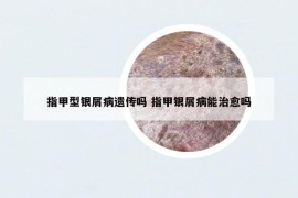 指甲型銀屑病遺傳嗎 指甲銀屑病能治愈嗎