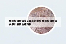 膿皰型銀屑病關(guān)節(jié)炎最新治療 膿皰型銀屑病關(guān)節(jié)炎最新治療藥物