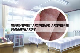 銀屑病對體銀行入職體檢貼吧 入職體檢有銀屑病會影響入職嗎?