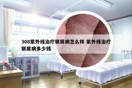 308紫外線治療銀屑病怎么樣 紫外線治療銀屑病多少錢