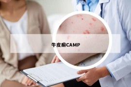 牛皮癬CAMP