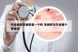 牛皮癬和蕁麻疹是一個(gè)嗎 蕁麻疹與牛皮哪個(gè)更難受