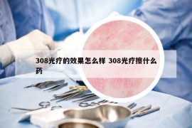 308光療的效果怎么樣 308光療擦什么藥