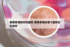 看銀屑病較好的醫(yī)院 看銀屑病去哪個醫(yī)院會比較好