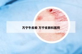 萬(wàn)寧牛皮癬 萬(wàn)寧皮膚科醫(yī)院
