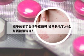 被子長(zhǎng)毛了會(huì)得牛皮癬嗎 被子長(zhǎng)毛了,什么東西能清洗凈?