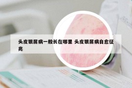 頭皮銀屑病一般長在哪里 頭皮銀屑病自愈征兆