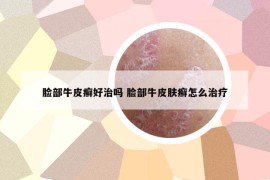 臉部牛皮癬好治嗎 臉部牛皮膚癬怎么治療