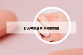 什么喊銀屑病 何謂銀屑病