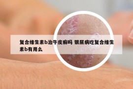 復(fù)合維生素b治牛皮癬嗎 銀屑病吃復(fù)合維生素b有用么