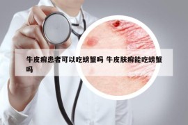 牛皮癬患者可以吃螃蟹嗎 牛皮膚癬能吃螃蟹嗎