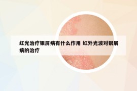 紅光治療銀屑病有什么作用 紅外光波對銀屑病的治療