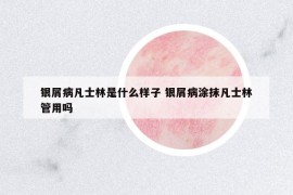 銀屑病凡士林是什么樣子 銀屑病涂抹凡士林管用嗎