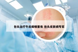 包頭治療牛皮癬哪里有 包頭皮膚病專家