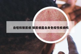 自噬和銀屑病 銀屑病是自身免疫性疾病嗎