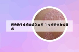 照光治牛皮癬光該怎么照 牛皮癬照光有效果嗎