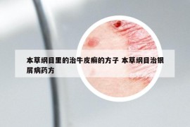 本草綱目里的治牛皮癬的方子 本草綱目治銀屑病藥方
