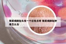 銀屑病腳趾頭有一個還有點(diǎn)疼 銀屑病腳趾腫痛怎么治