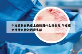 牛皮廨長(zhǎng)在頭皮上應(yīng)該用什么洗頭發(fā) 牛皮廨治療什么特效藥膏頭部