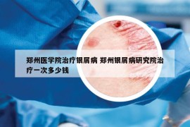 鄭州醫(yī)學院治療銀屑病 鄭州銀屑病研究院治療一次多少錢