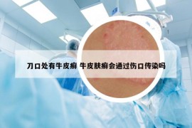刀口處有牛皮癬 牛皮膚癬會(huì)通過傷口傳染嗎