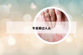 牛皮癬過人么