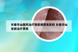 長(zhǎng)春華山醫(yī)院治療銀屑病費(fèi)用高嗎 長(zhǎng)春華山皮膚治療費(fèi)貴