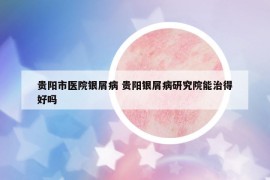 貴陽市醫(yī)院銀屑病 貴陽銀屑病研究院能治得好嗎